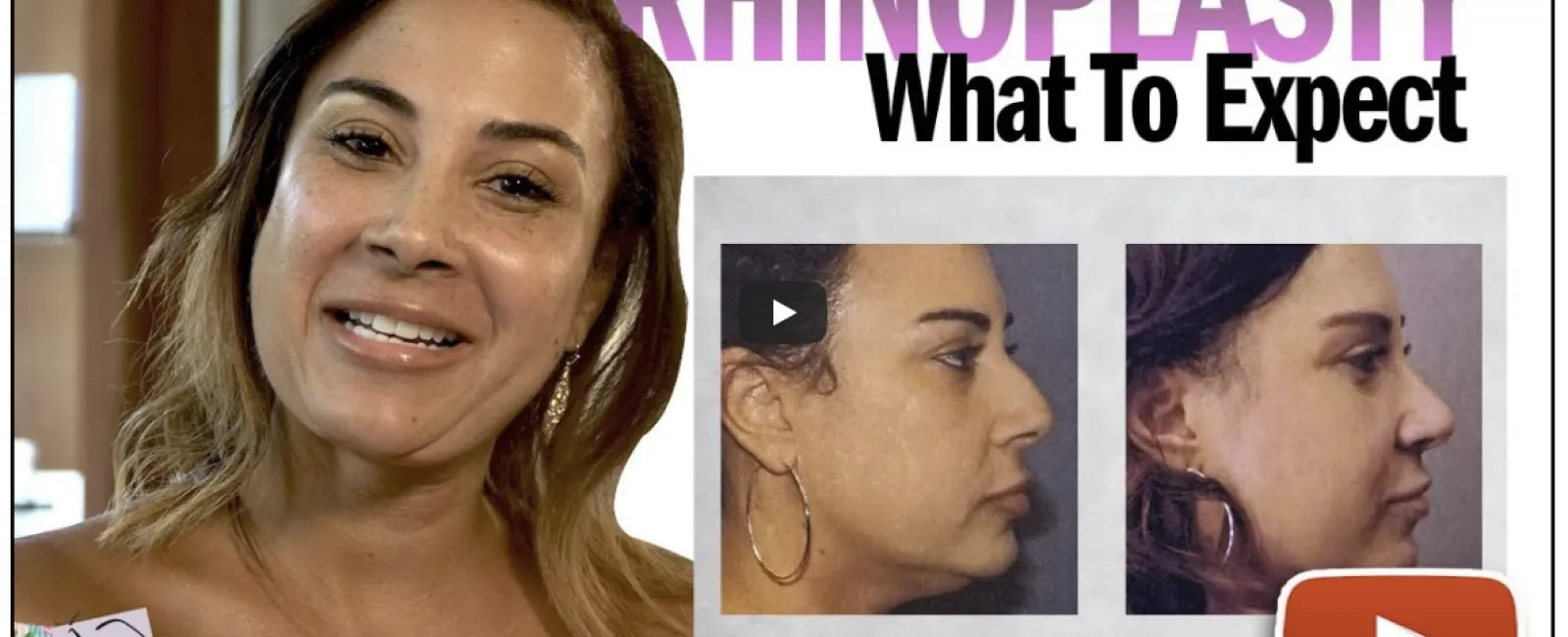 Rhinoplasty Video Case Study