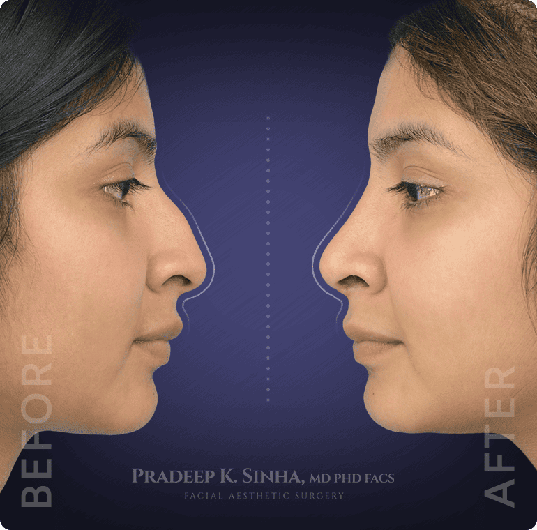 Ethnic Rhinoplasty Atlanta