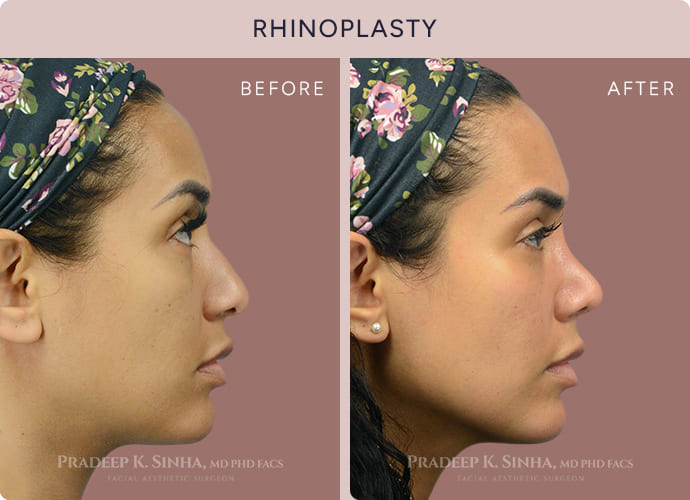 Ethnic Rhinoplasty Atlanta