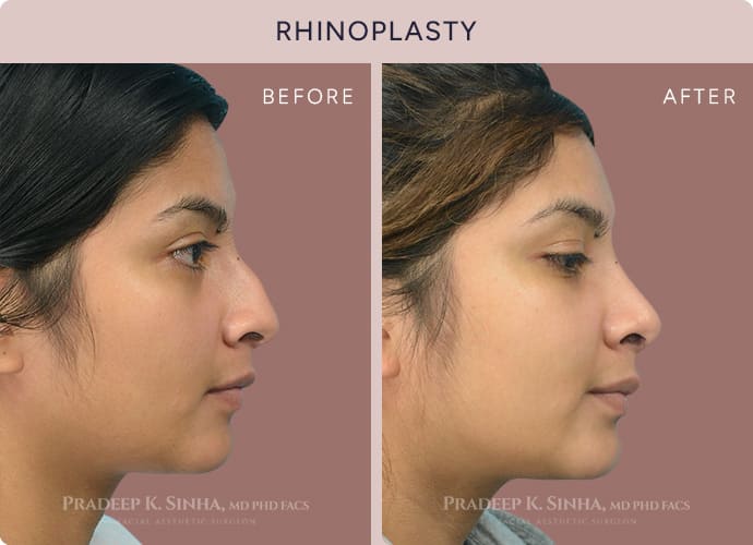 Ethnic Indian Rhinoplasty