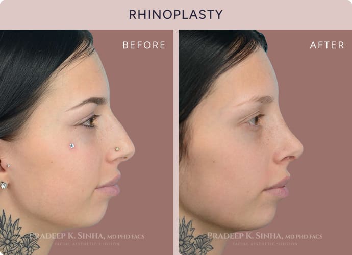 Rhinoplasty - Facial Aesthetic Surgery