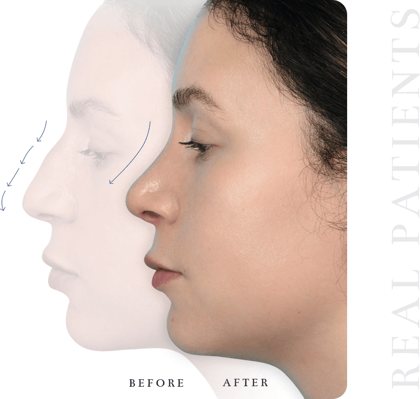 WHAT IS RHINOPLASTY - Facial Aesthetics Surgery