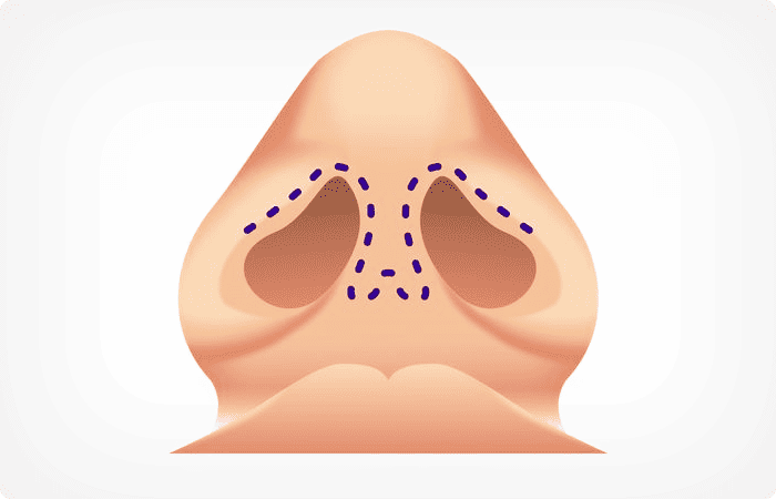 Closed Rhinoplasty Image - Facial Aesthetics Surgery