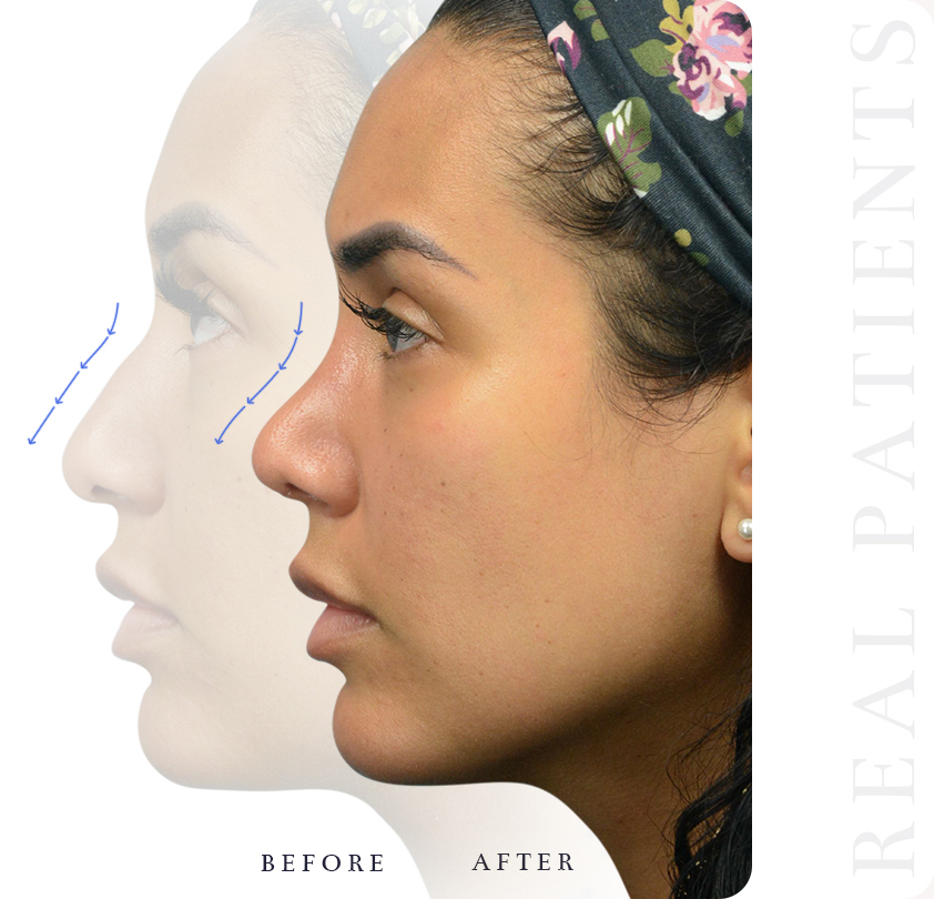 Ethnic Rhinoplasty Atlanta GA