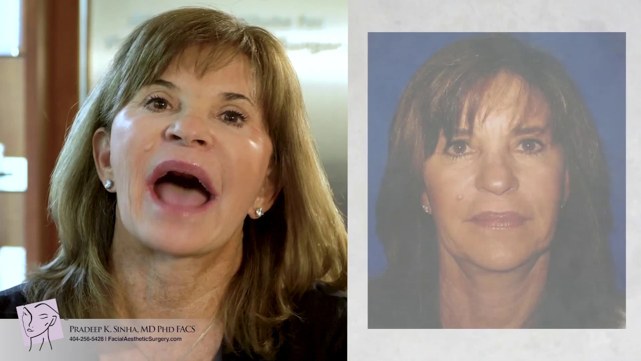 Facelift - Choosing Dr. Pradeep Sinha