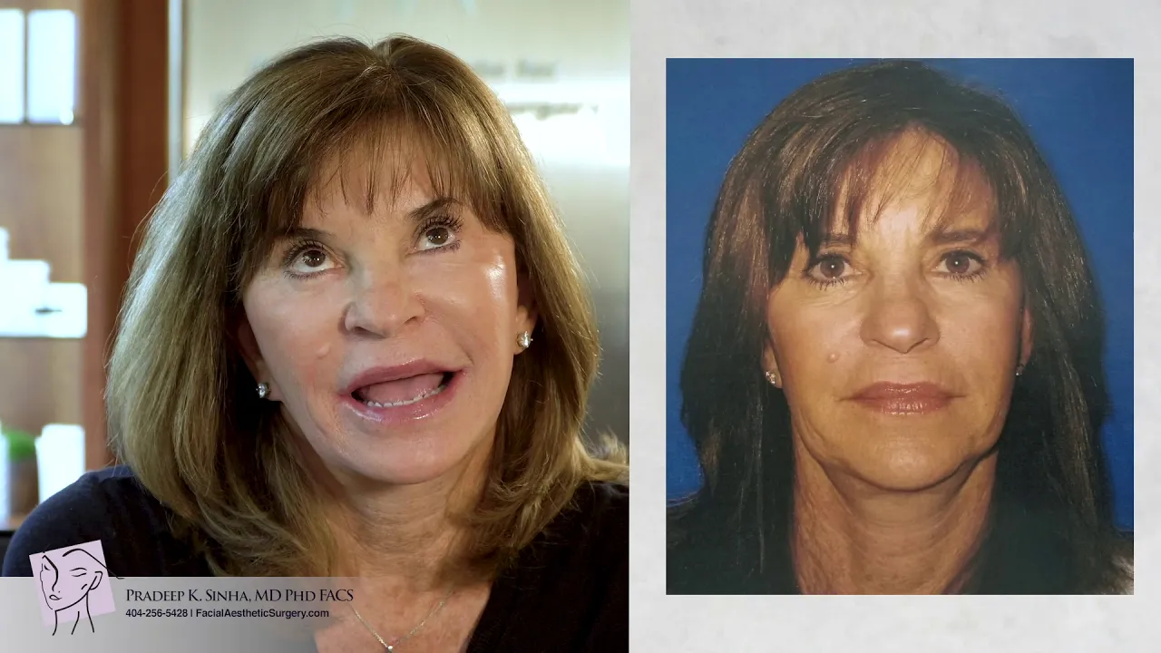Facelift - Real Patient Results - Facial Aesthetics Surgery