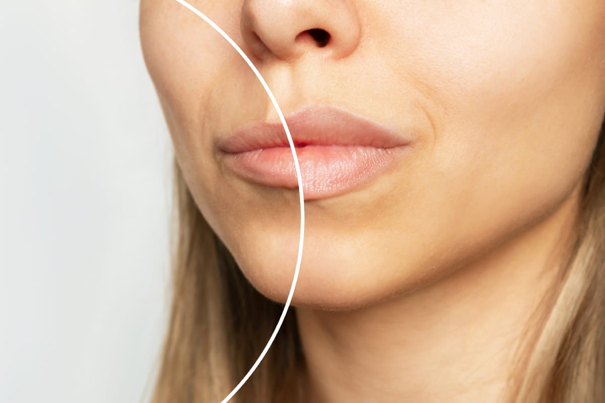 Lip Filler Image Main - Facial Aesthetics Surgery
