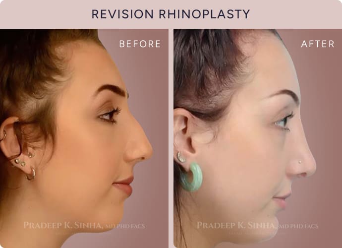 Revision Rhinoplasty Before & After 2 - Facial Aesthetics Surgery