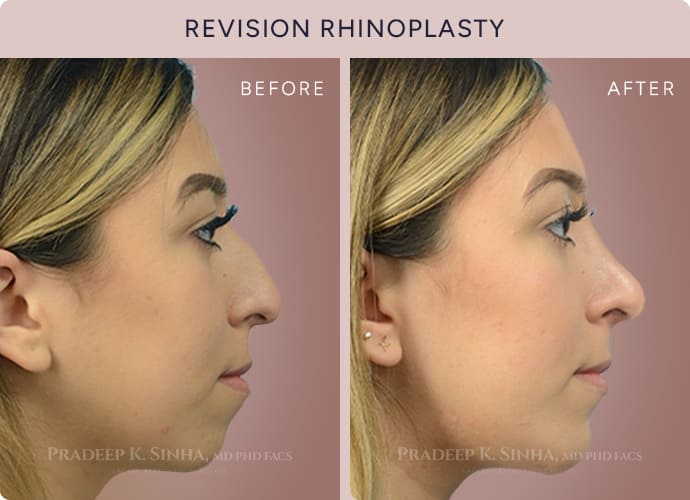 Revision Rhinoplasty Before & After - Facial Aesthetics Surgery