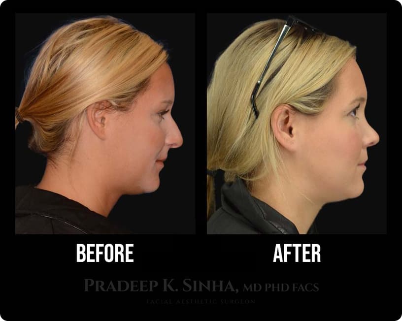 What is Revision Rhinoplasty - Facial Aesthetics Surgery