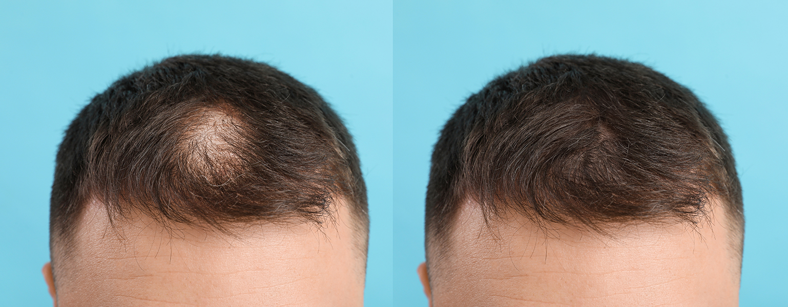 hair-before-after - Facial Aesthetics Surgery