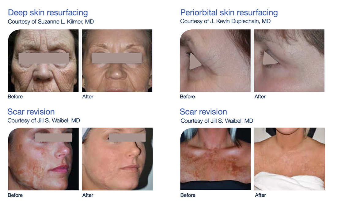 fractional-co2-laser-sinha-case-studies