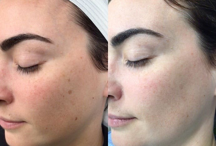 Benefits of IPL Therapy