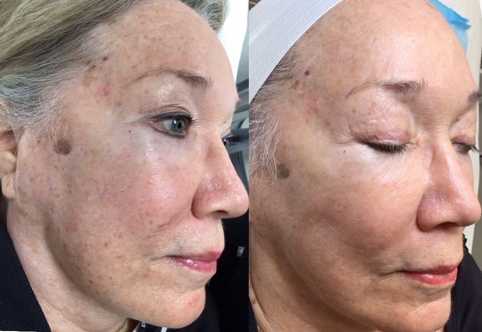 Candidates for RF Microneedling-2