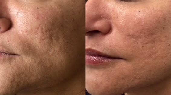 Candidates for RF Microneedling