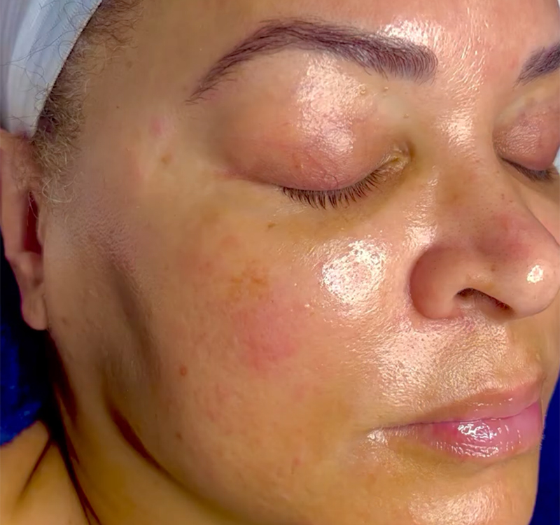 Cleanses-pores-deeply-Facial-Aesthetic-Surgery