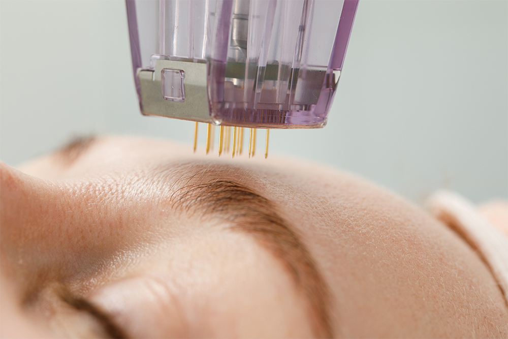Microneedling-Work