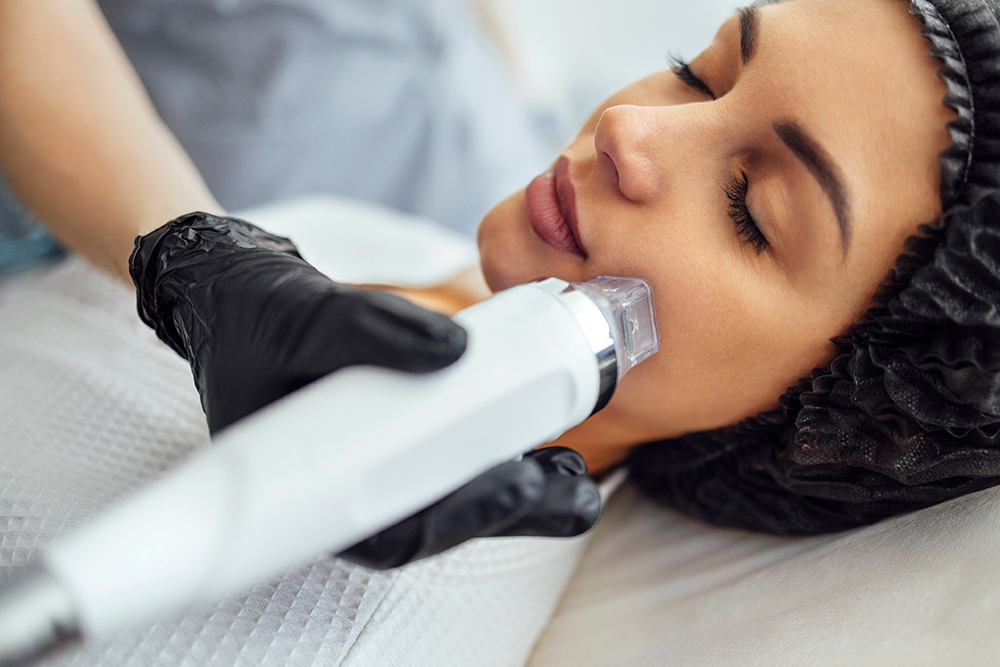 Microneedling with RF: