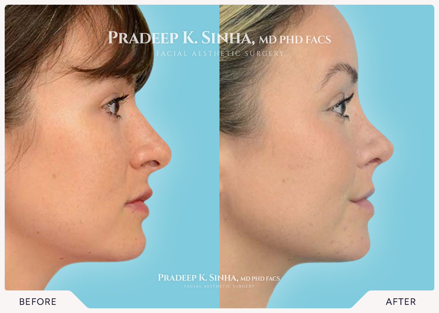 Rhinoplasty