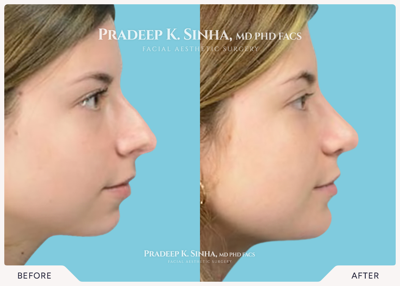 Rhinoplasty
