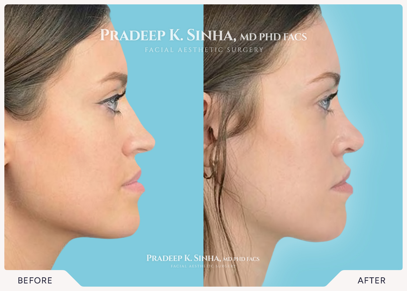 Rhinoplasty