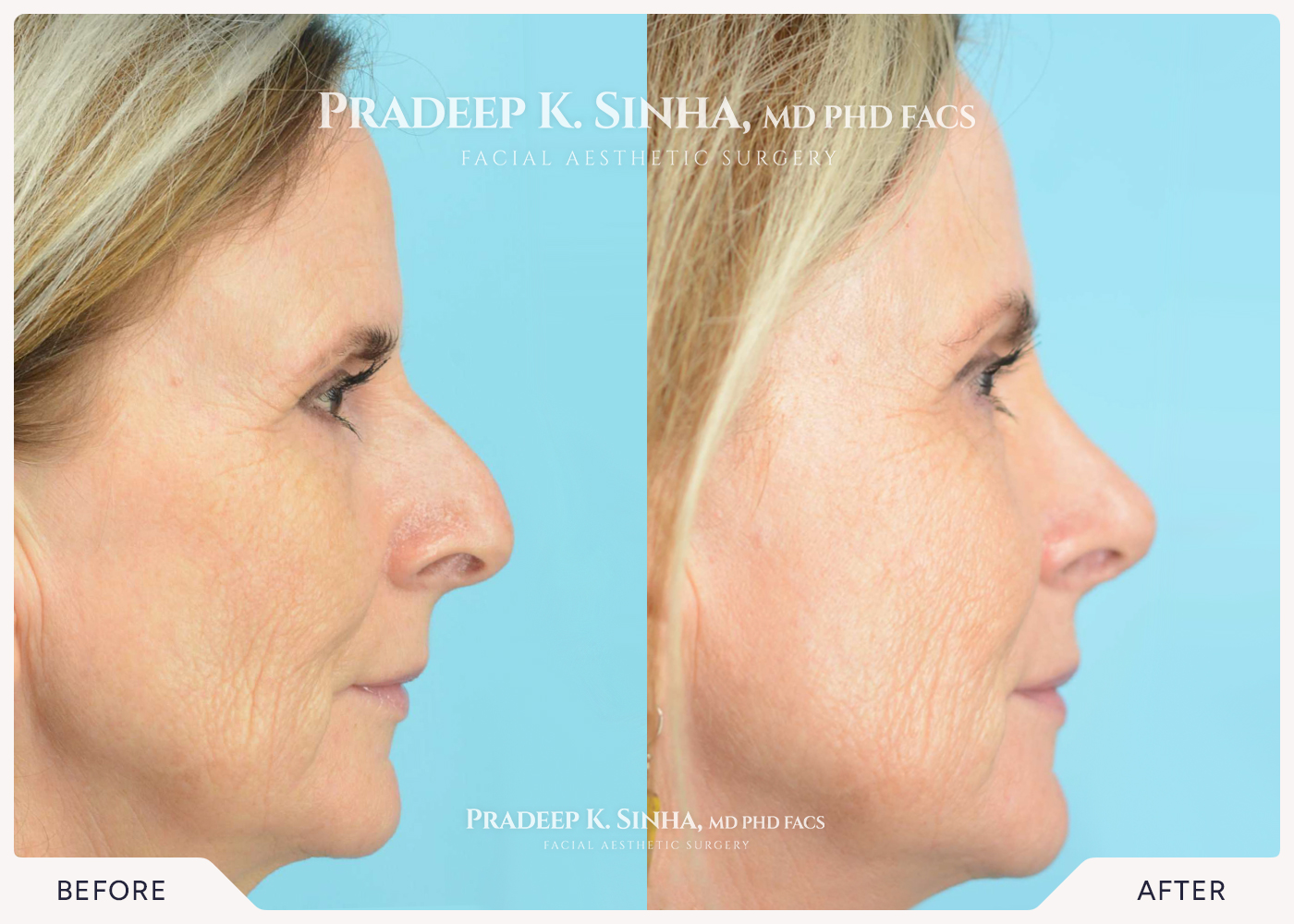 Rhinoplasty