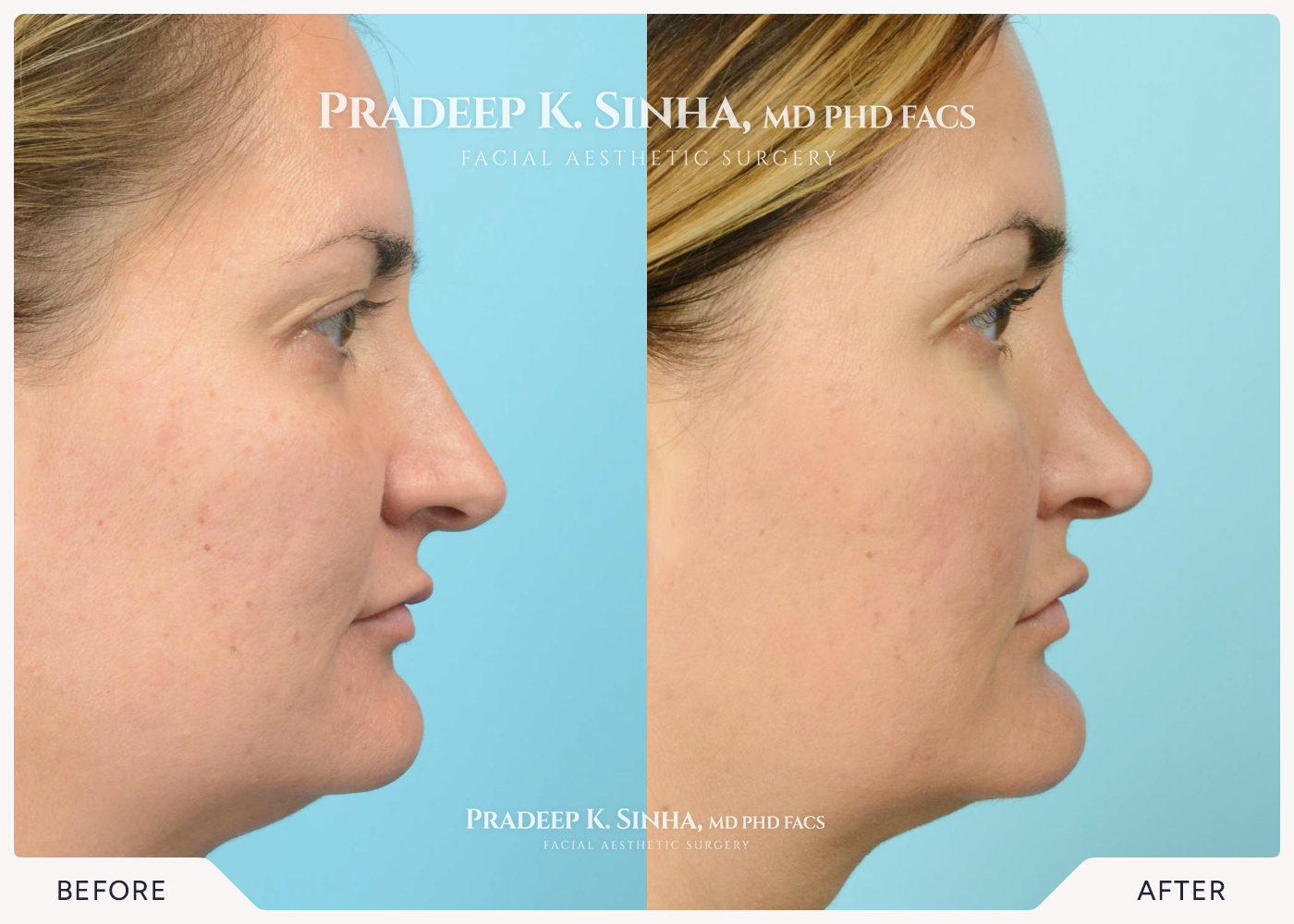 Rhinoplasty
