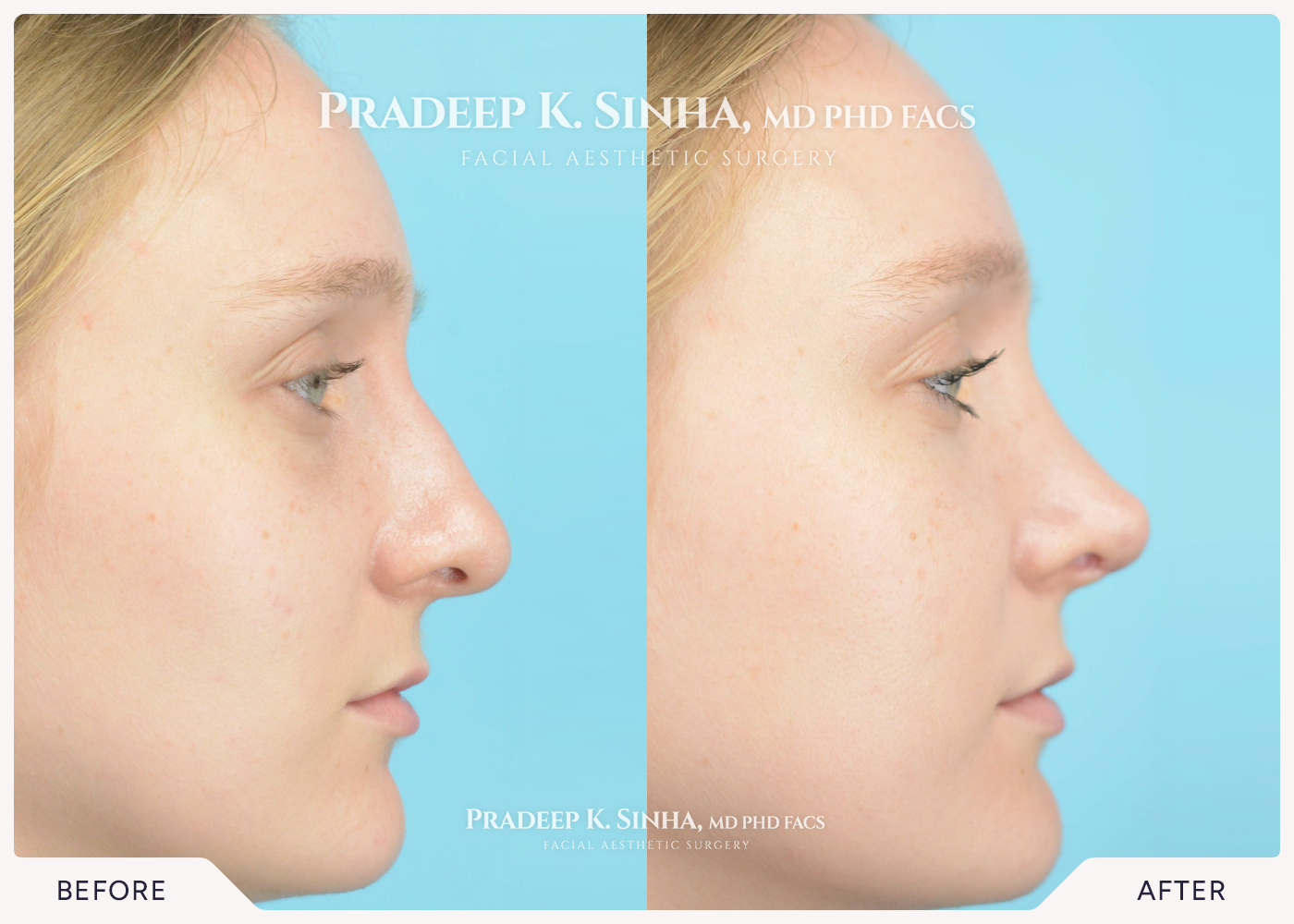 Rhinoplasty