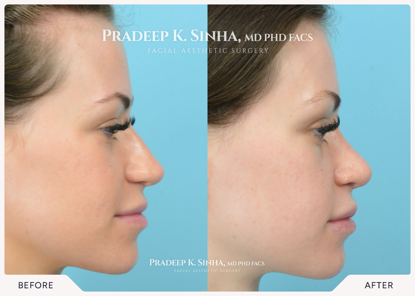 Rhinoplasty