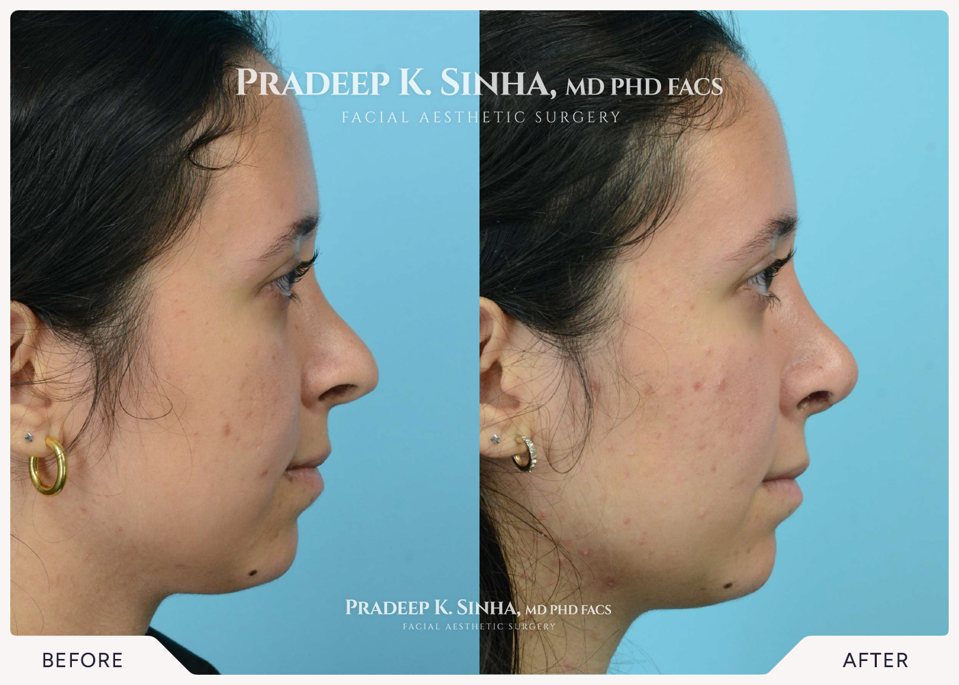 Rhinoplasty