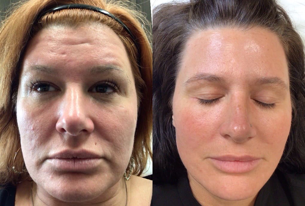 The light energy penetrates deep into the skin