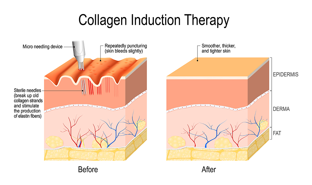 collagen-before-after
