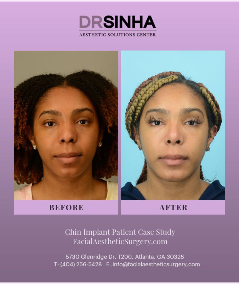 facialaestheticsurgerynew_874874042