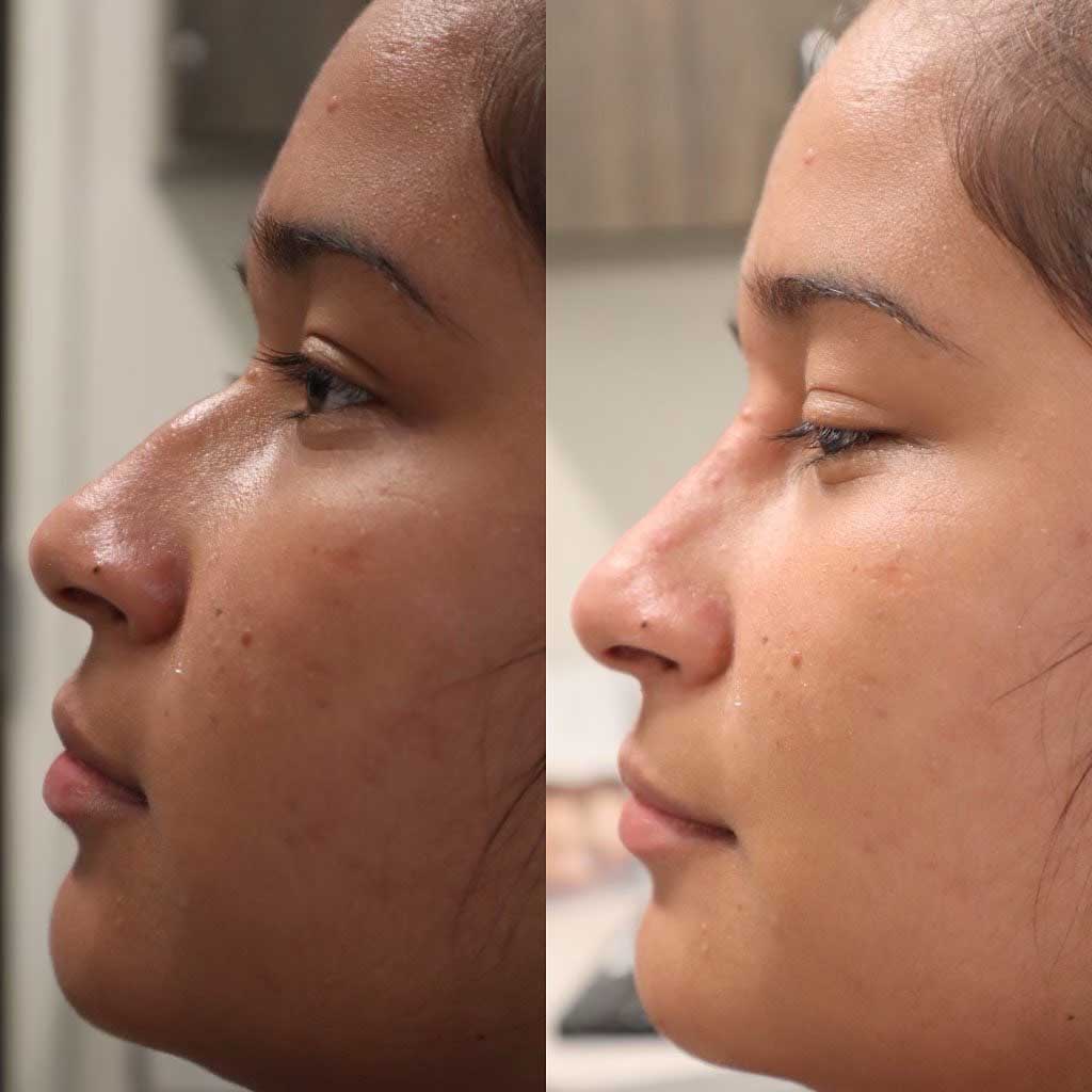 liquid-rhinoplasty