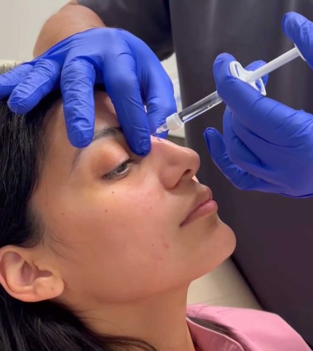 non-surgical-rhinoplasty-atlanta
