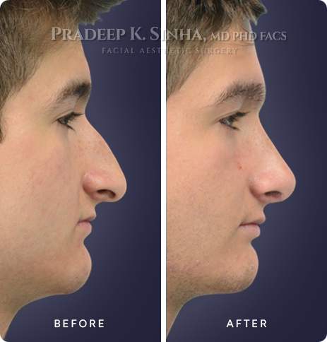 rhinoplasty-atlanta-b-9