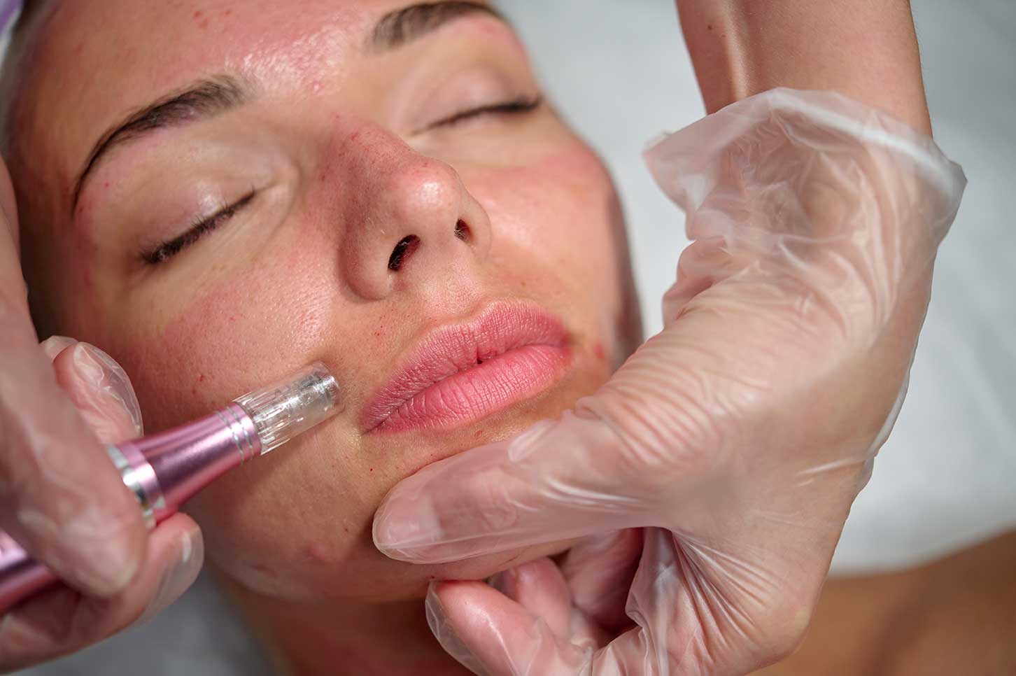 skinpen-2