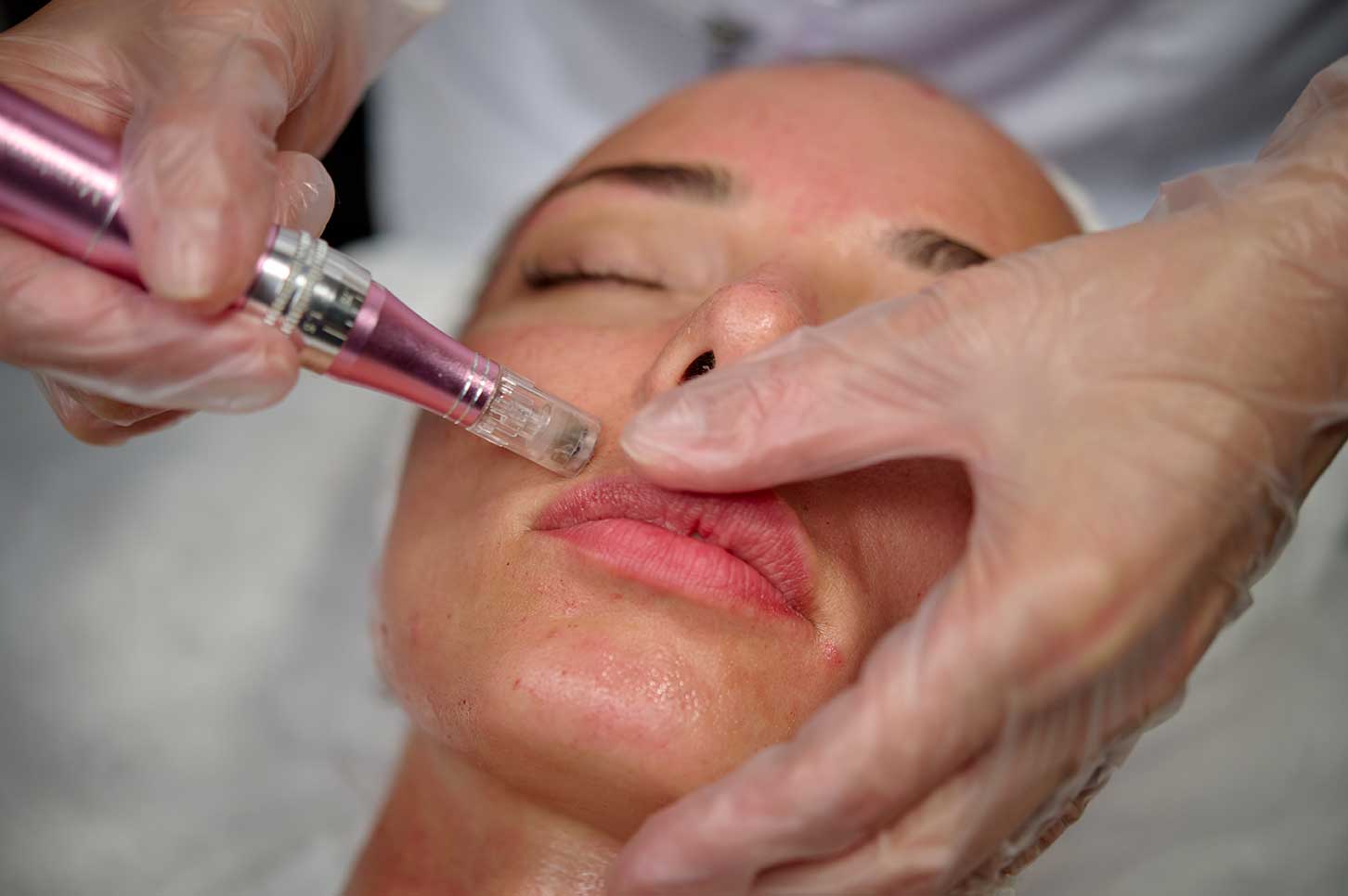skinpen1