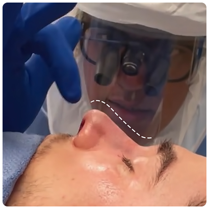 rhinoplasty_Sections_After