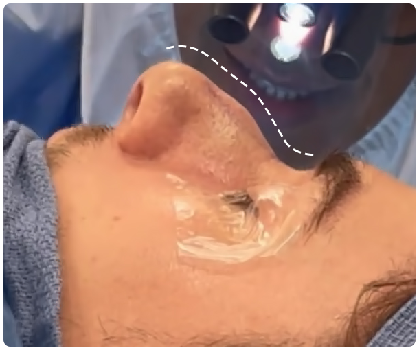 rhinoplasty_Sections_Before