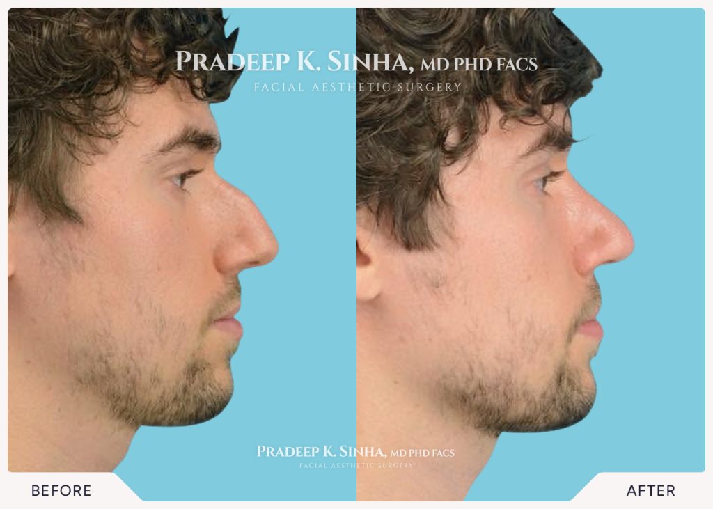 Rhinoplasty-atlanta-1