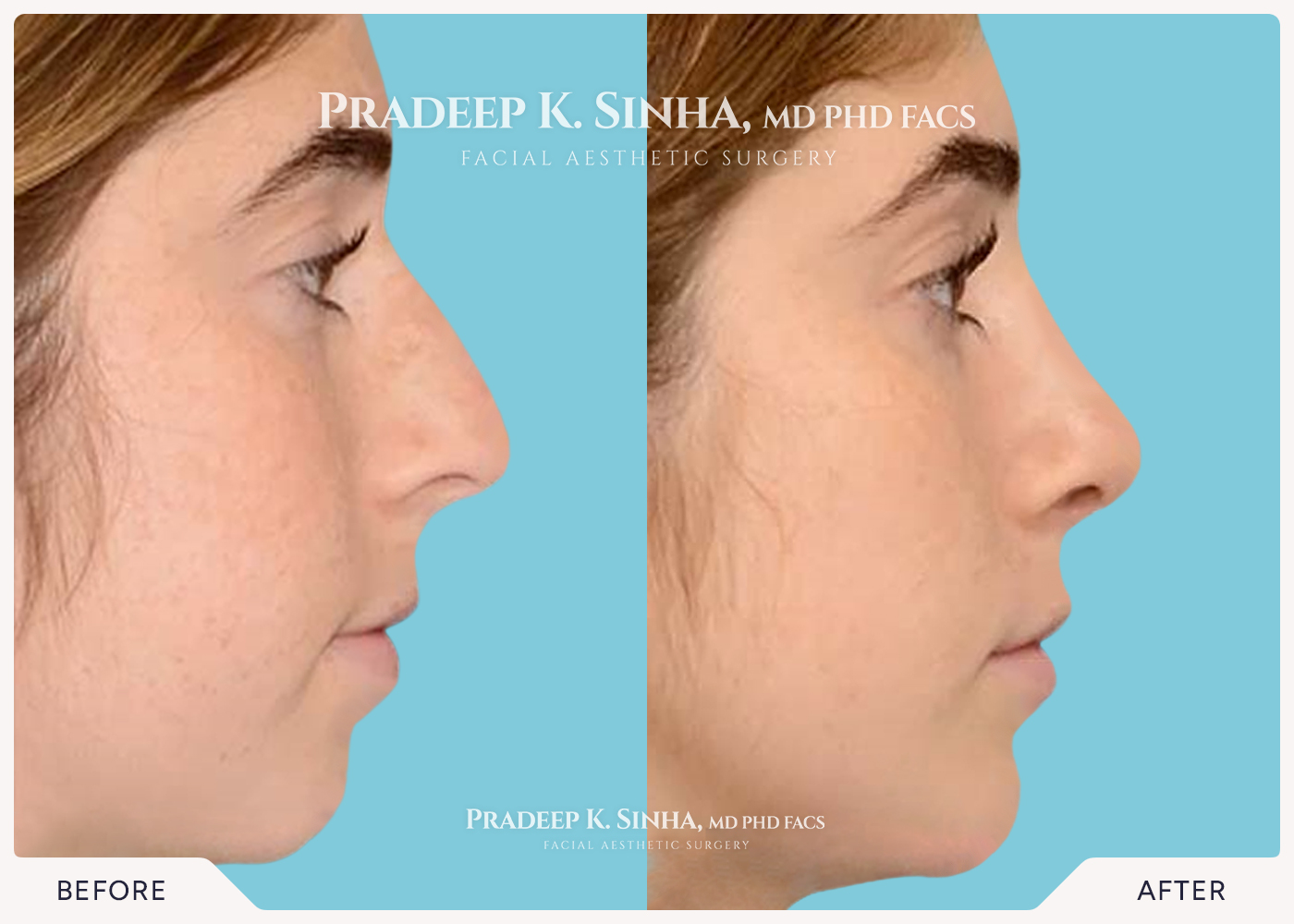 Rhinoplasty