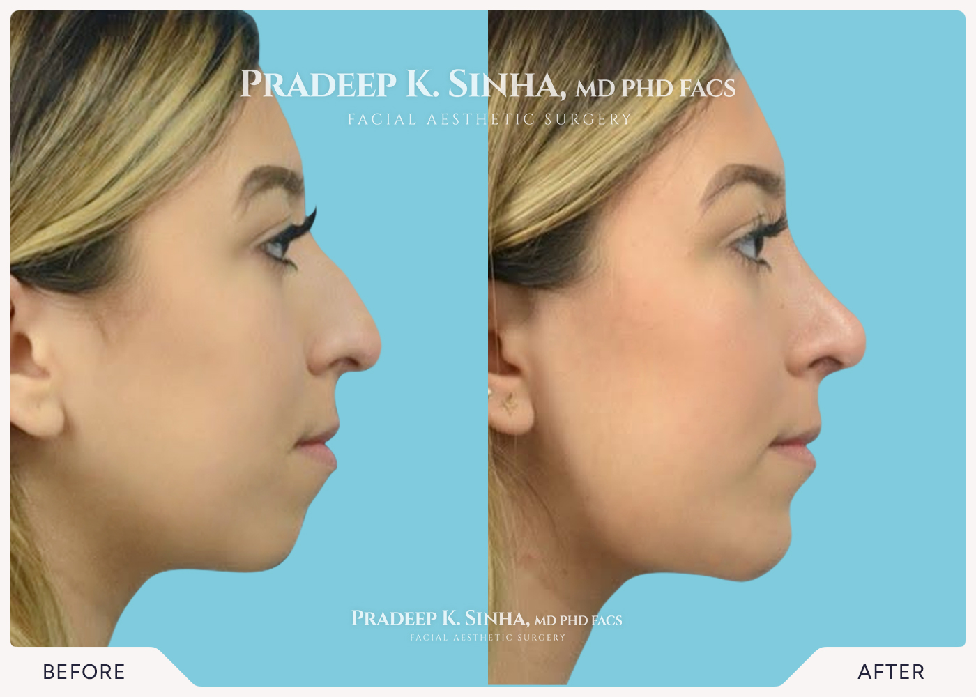 Rhinoplasty