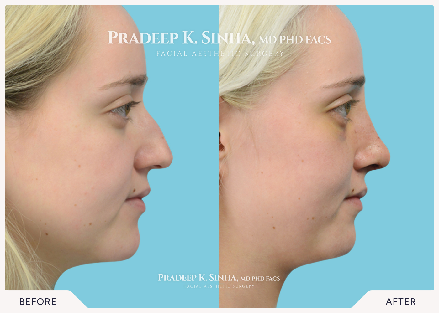 Rhinoplasty