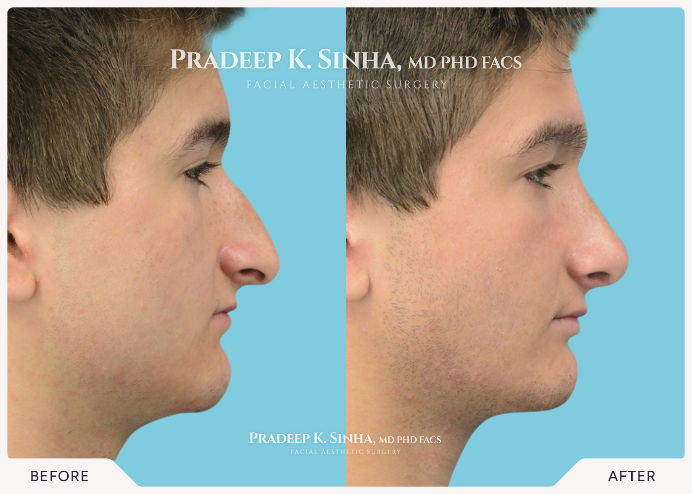 Rhinoplasty