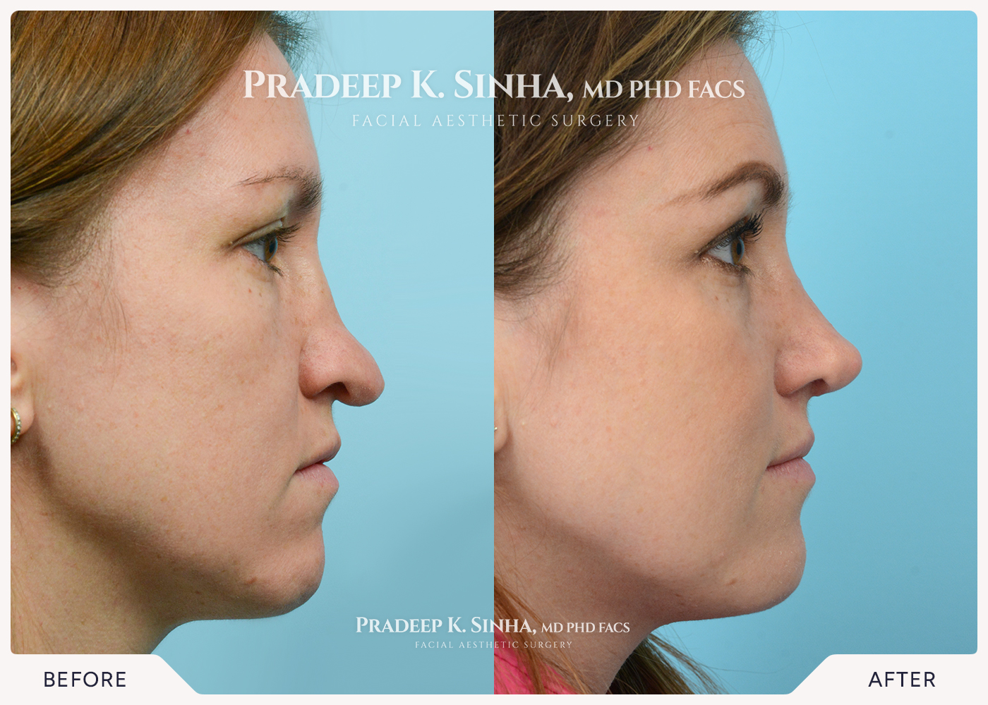 Rhinoplasty