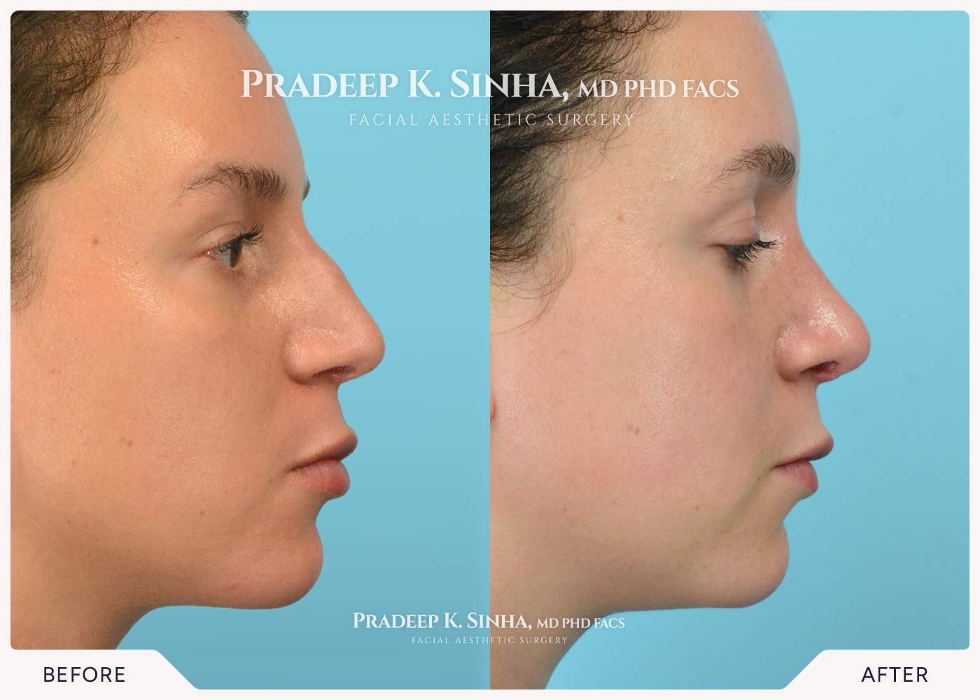 Rhinoplasty