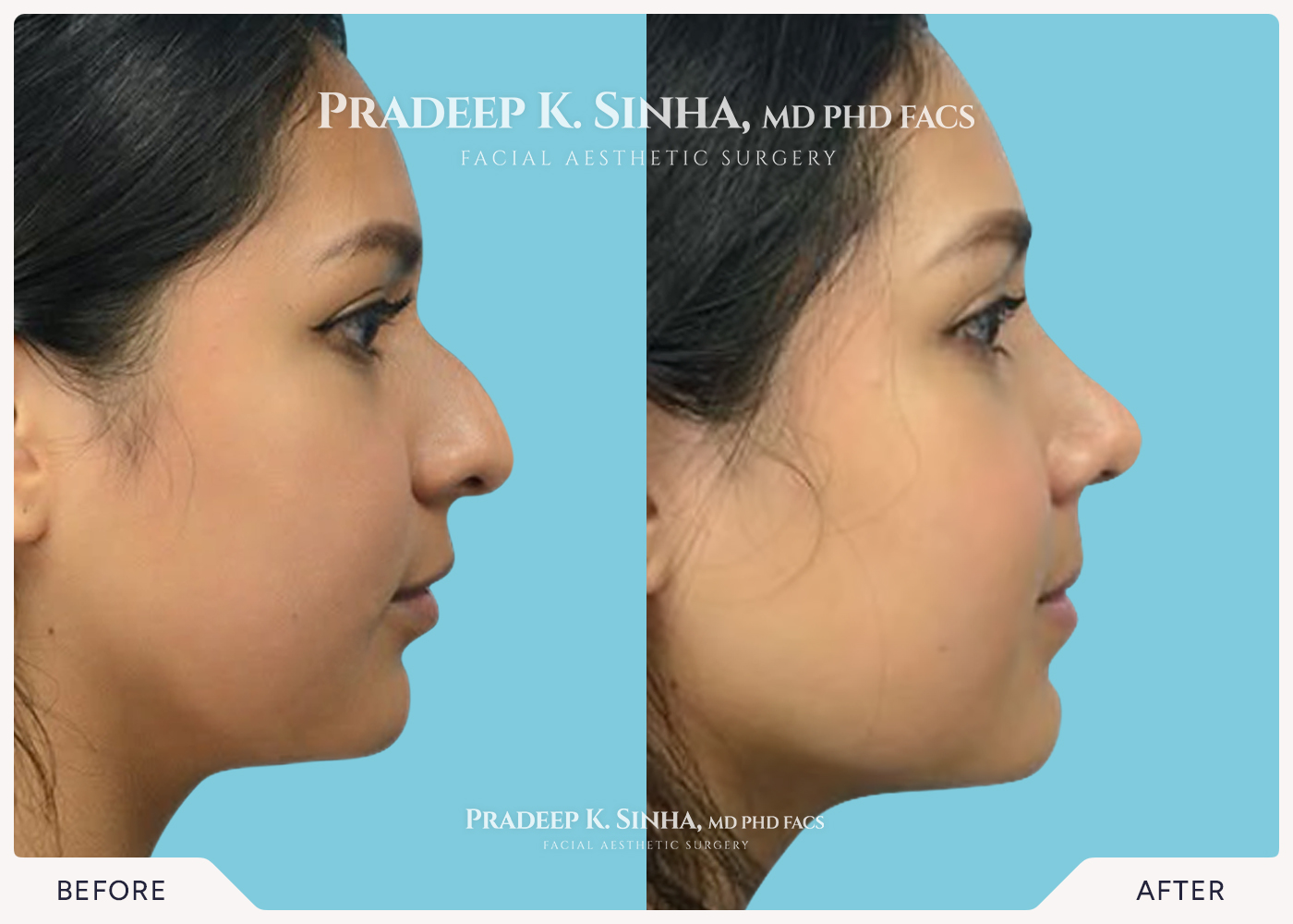 Rhinoplasty