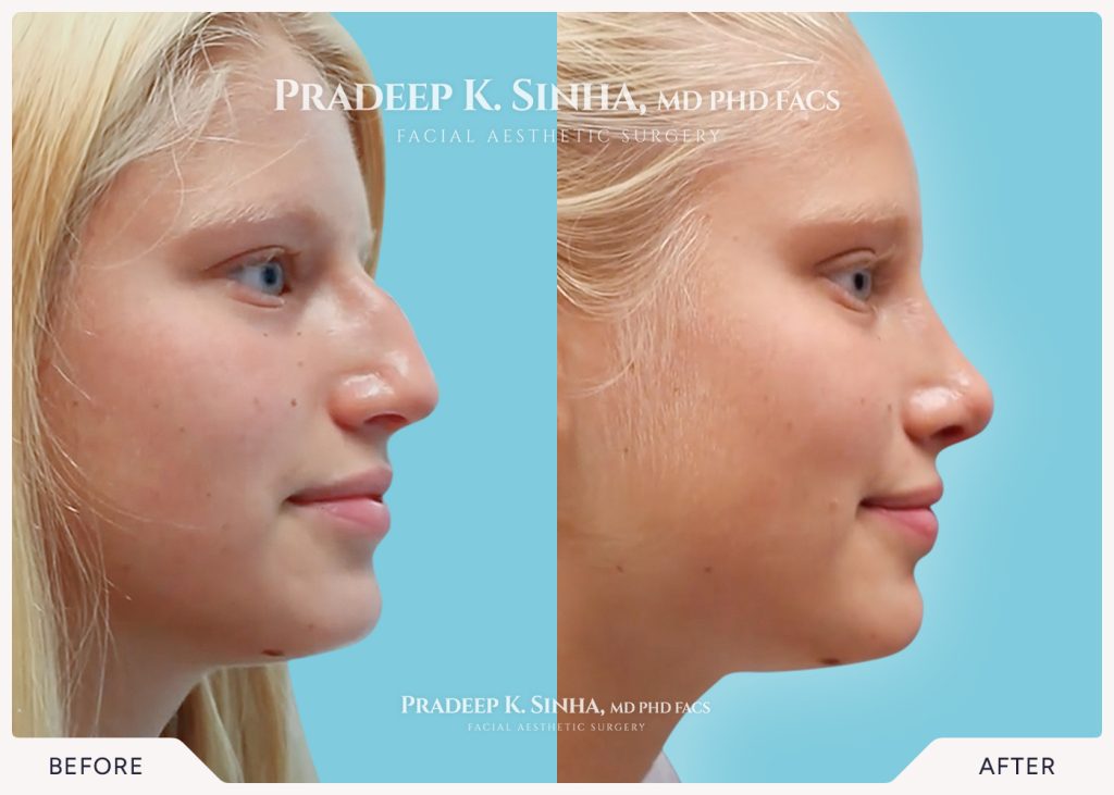 Rhinoplasty-atlanta-8