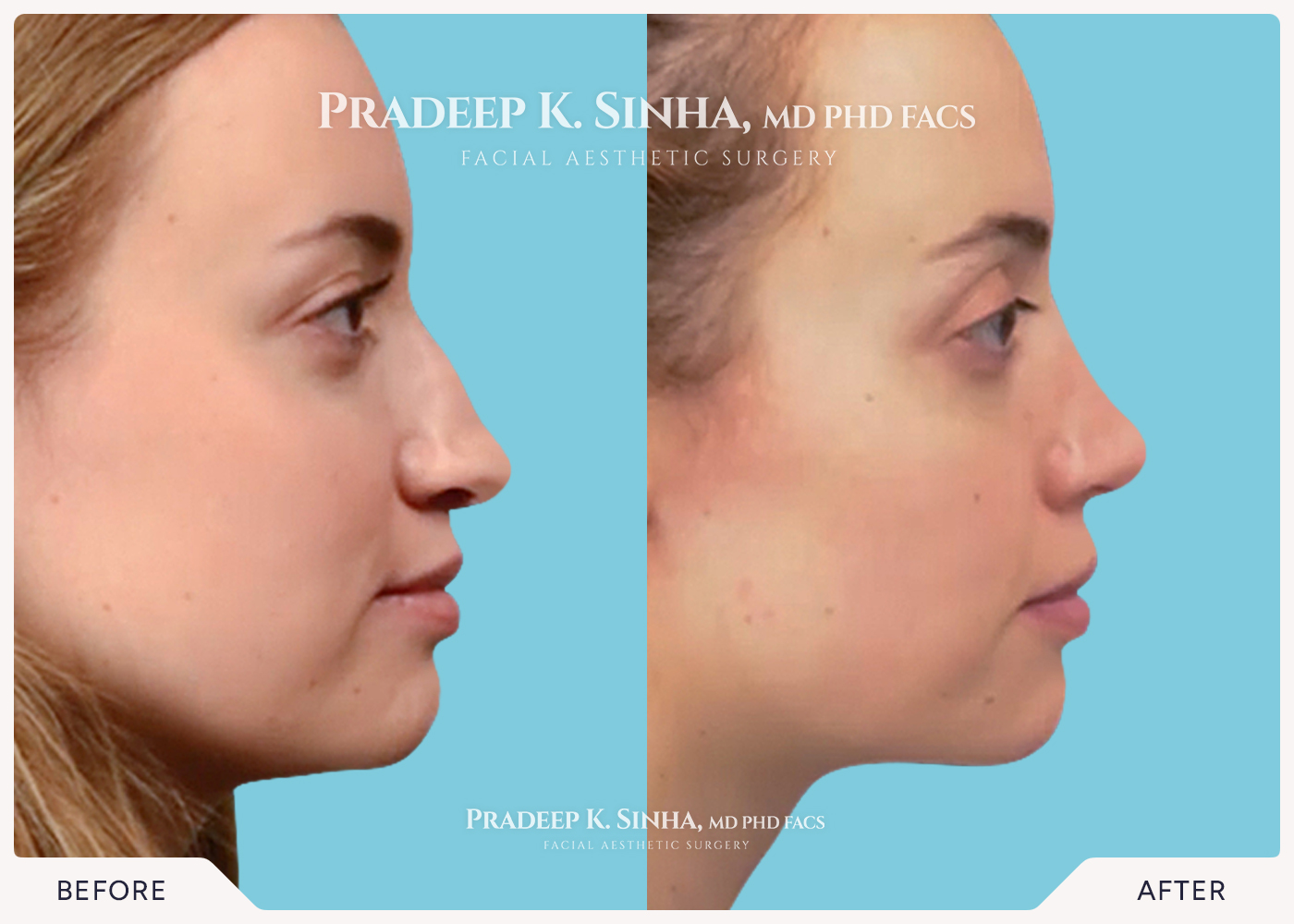 Rhinoplasty